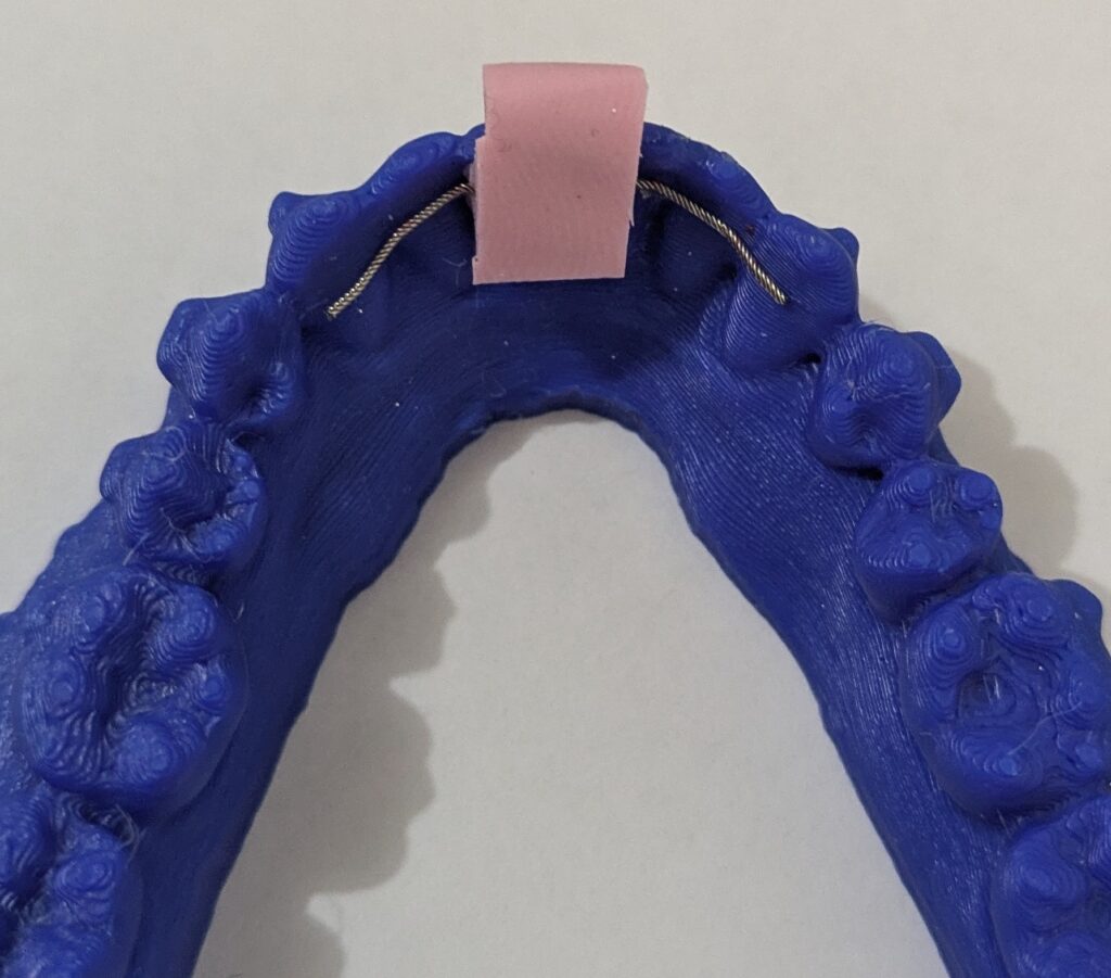 A blue dental mold with a putty key and wire retainer, for orthodontic use.