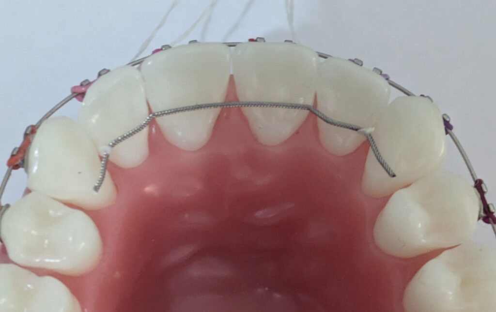 Placing wire with floss