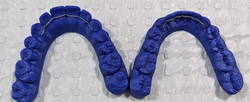 Two blue dental molds, one for the upper teeth and one for the lower teeth, displayed on a textured surface.